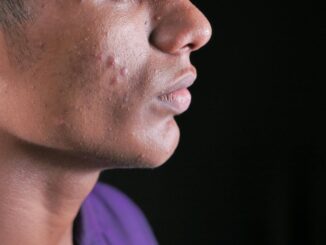 Rimedi contro i brufoli occhio all’alimentazione