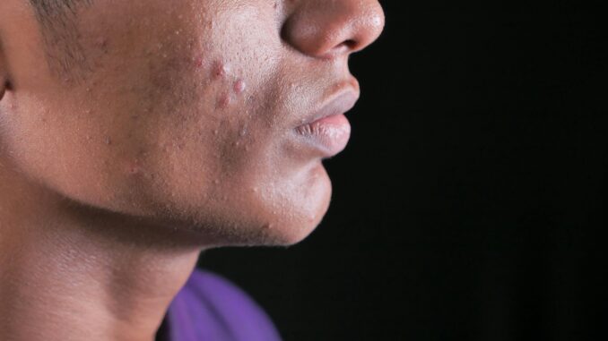 Rimedi contro i brufoli occhio all’alimentazione